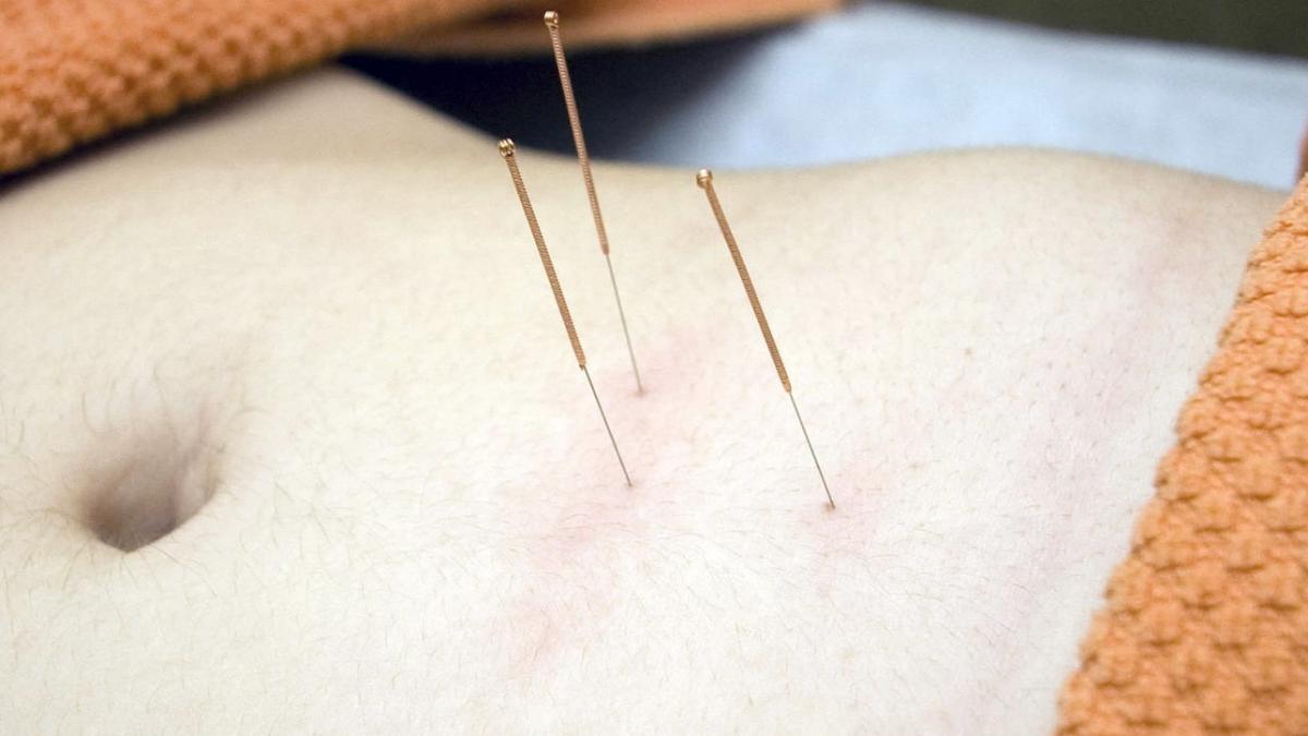 Acupuncture à Namur - Wazaa