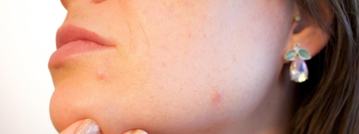 Dermatologist in brussel
